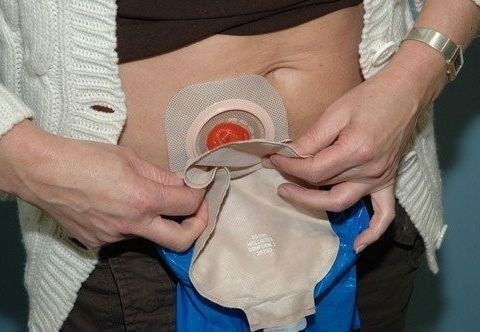 Vì sao bệnh nhân ung thư trực tràng thường phải mang hậu môn nhân tạo